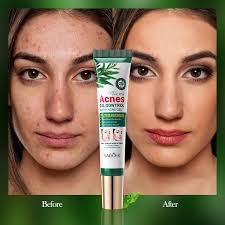 20g Tea Tree Acne Oil Control Gel